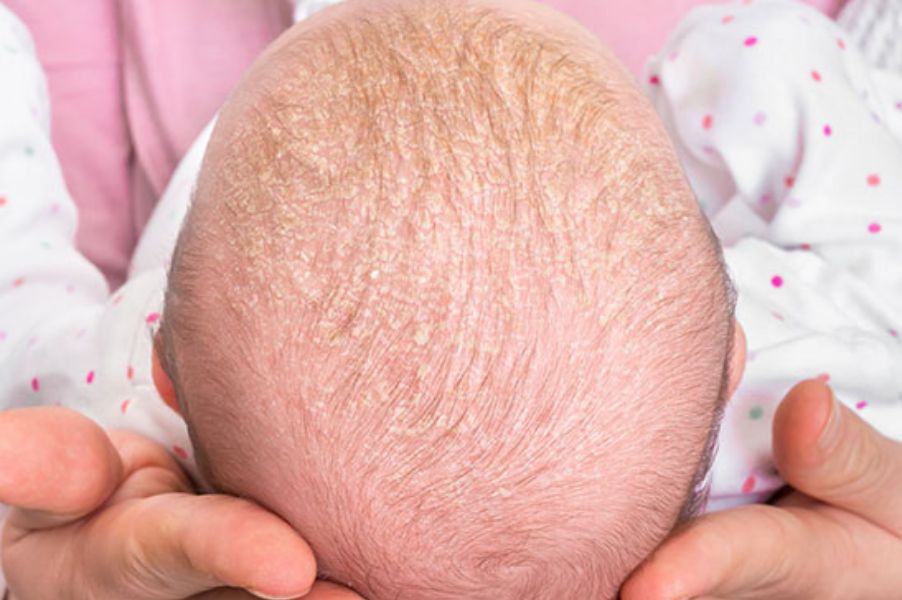 Why-Do-Babies-Get-Cradle-Cap